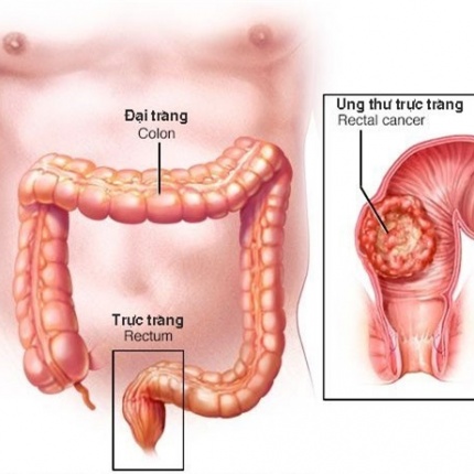 Nguy cơ ung thư đại tràng từ các món bún, phở