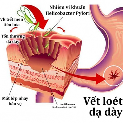 TẦM SOÁT HP - KIỂM SOÁT NGUYÊN NHÂN GÂY UNG THƯ DẠ DÀY